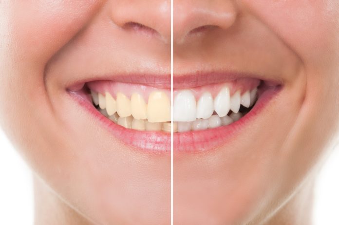  4 mënyra natyrale si t’i zbardhoni dhëmbët